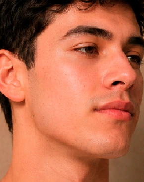 El mismo paciente con la piel del rostro despejada después de cuatro meses