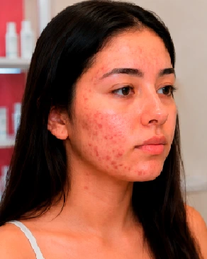 Paciente mujer con acné y marcas rojas en la mejilla antes del tratamiento