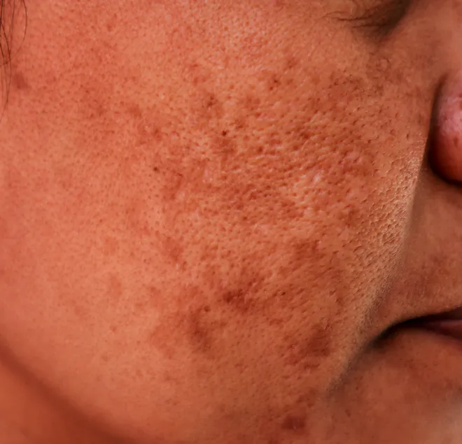 Parches de melasma en la mejilla de una paciente